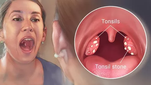 tonsilstones verwijderen
